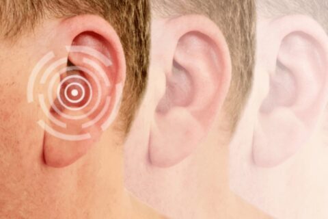 A significant representation of mild hearing loss in Naples and Estero, FL